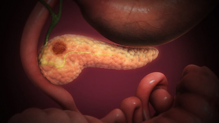 Daraxonrasib, un medicinale per il potenziale trattamento del PDAC? 1
